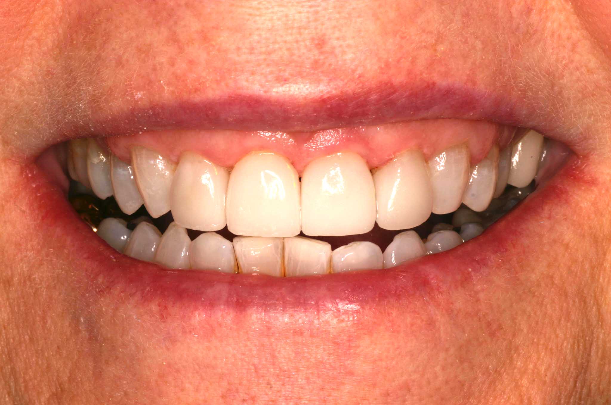 Close up of an actual patient mouth after receiving a smile makeover from Dr. Joe, a dentist in Poway, CA