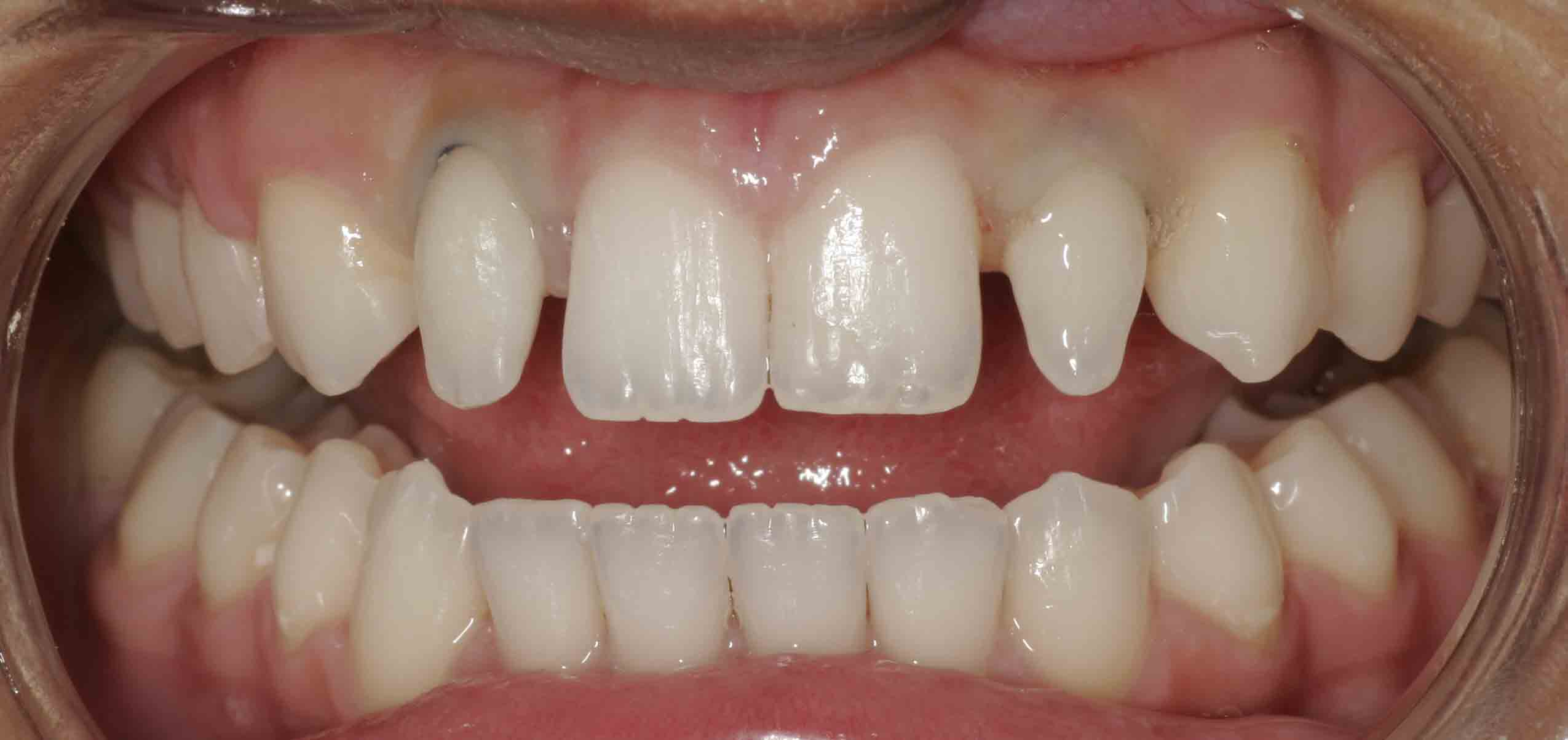 Close up of an actual patients mouth before receiving porcelain veneers in Poway CA