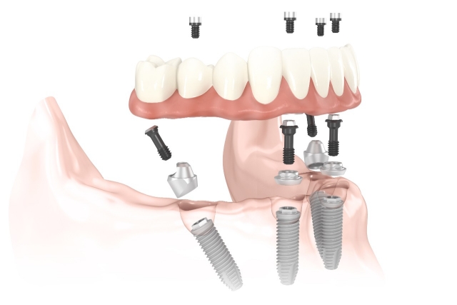 Illustration of all on 4 dental implants and how they are placed