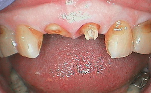 Close up of an actual patient mouth with two missing front teeth before receiving dental implants