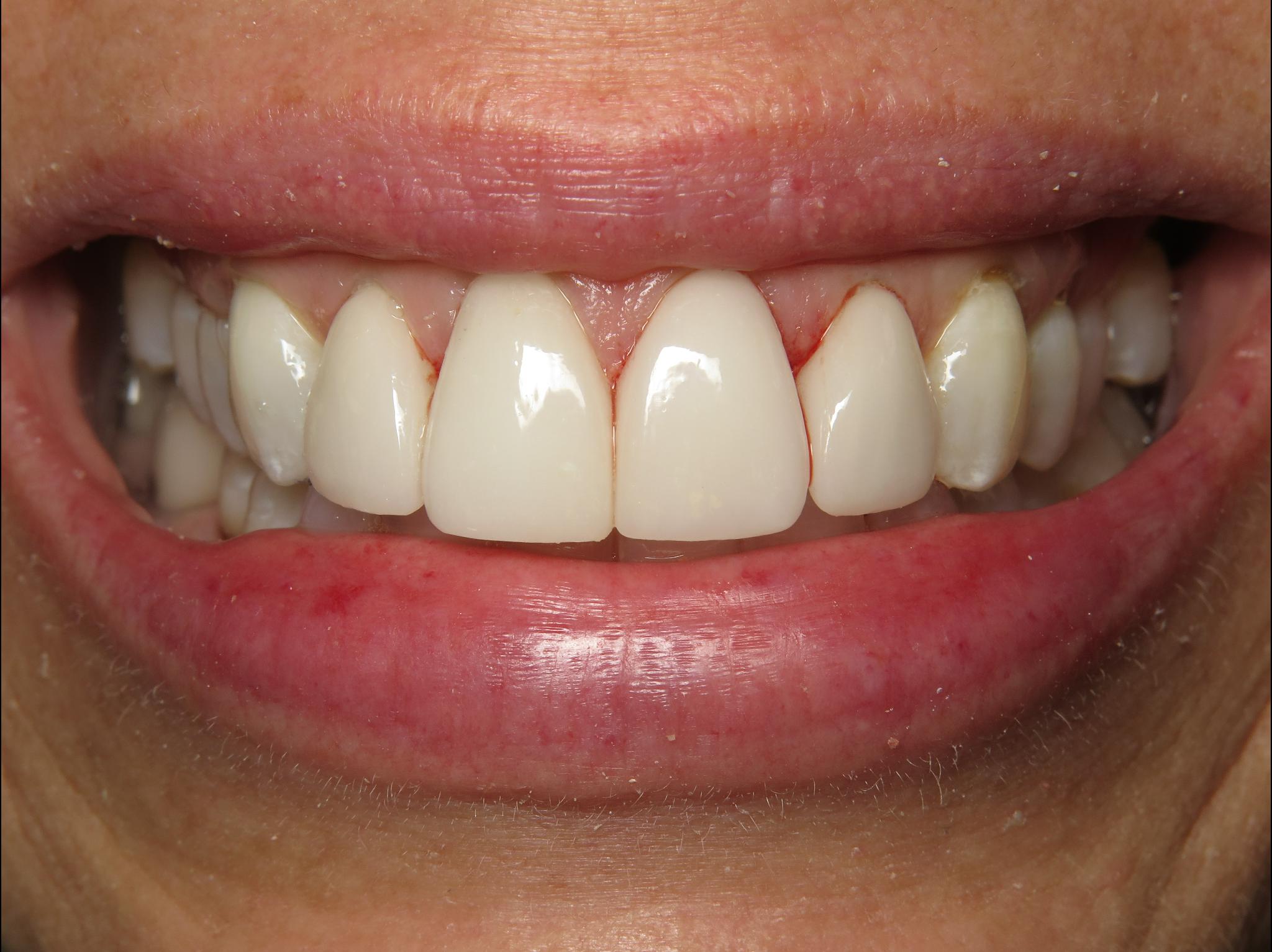 restored front tooth and veneers