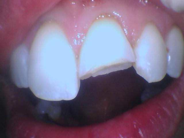 broken front tooth