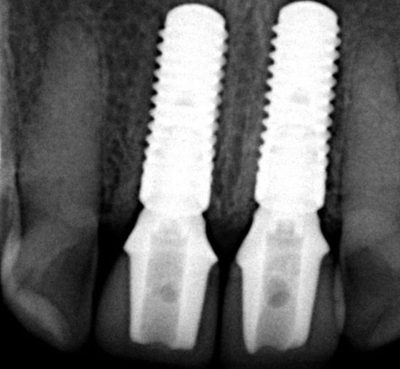 Xray of an actual patients mouth with dental implants placed