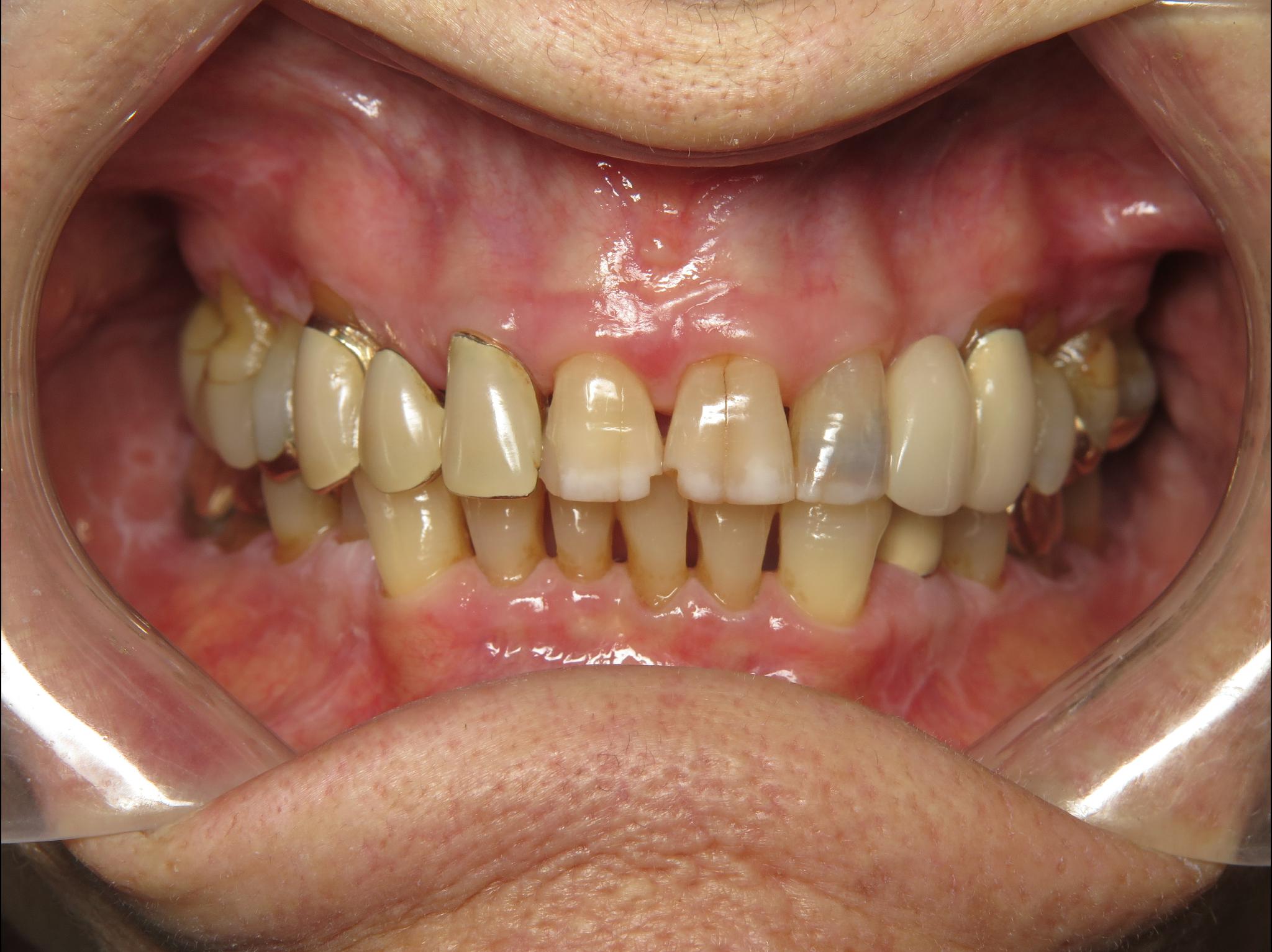 chipped teeth and leaking restorations