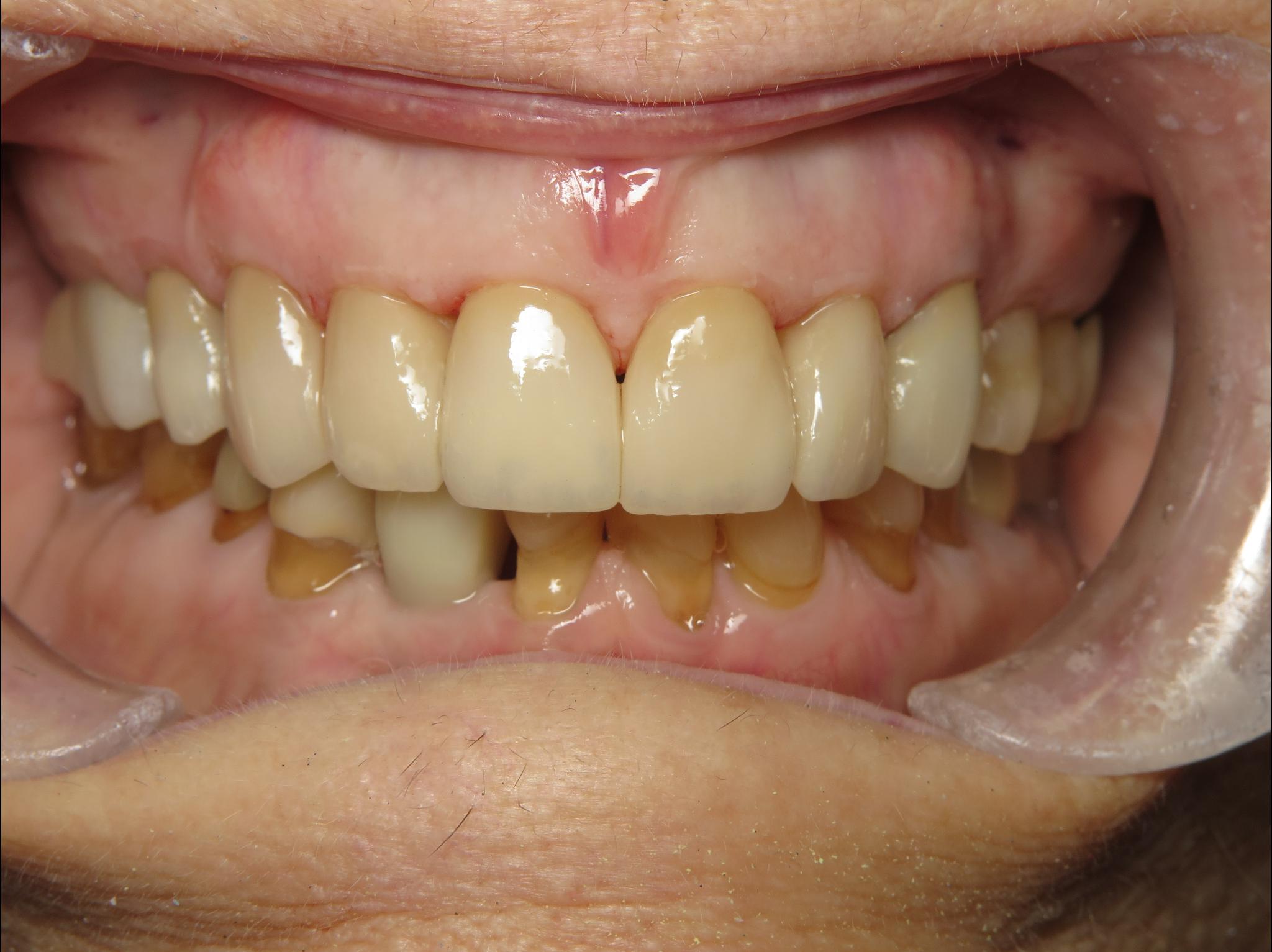 Close up of an actual patient mouth after receiving a smile makeover from Dr. Joe, a dentist in Poway, CA