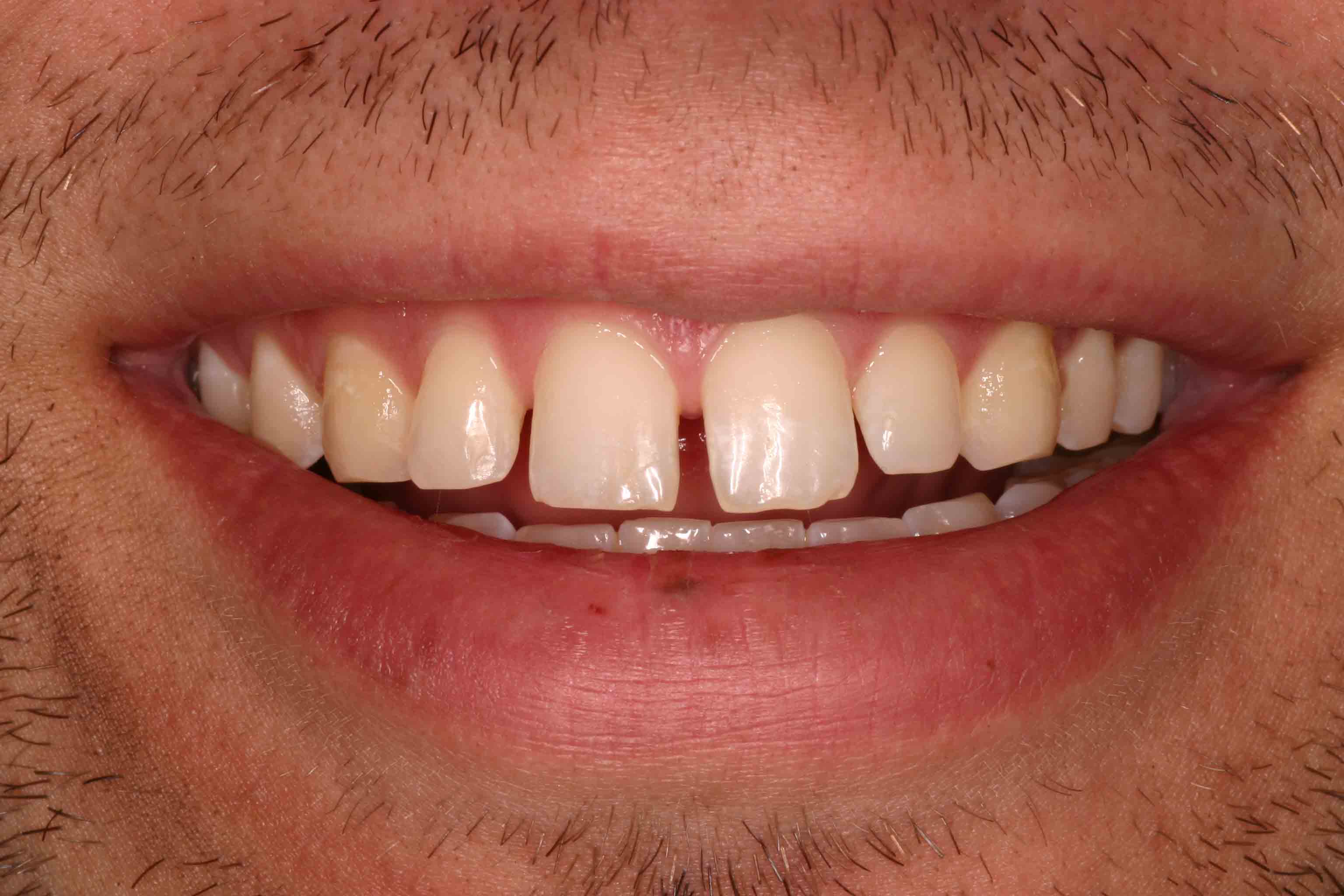 Close up of an actual patient mouth before receiving a smile makeover from Dr. Joe, a dentist in Poway, CA