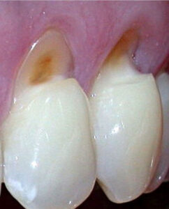 gingival cleaning