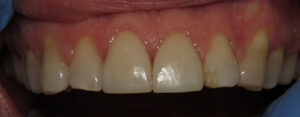 porcelain crowns