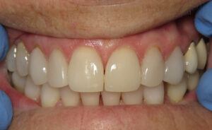 porcelain veneers