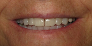 veneers