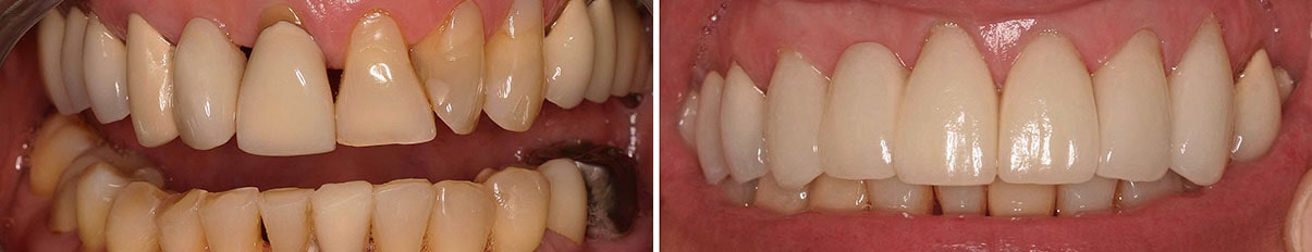 Before and after of a patient's smile with porcelain veneers