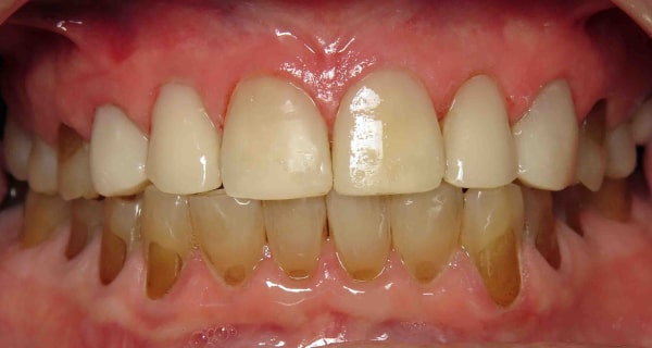 Close up of an actual patients mouth after receiving smile design dental services in Poway CA