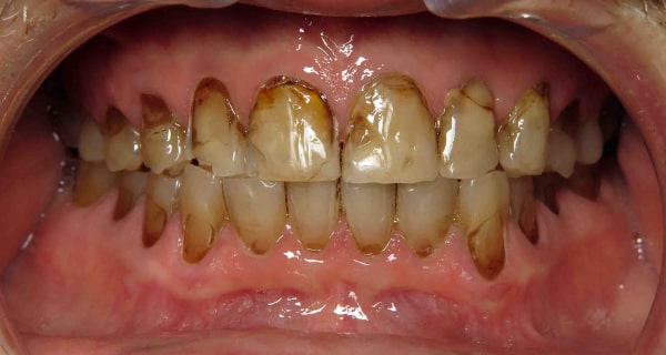 Close up of an actual patients mouth before receiving affordable smile design in Poway CA