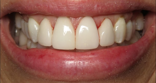 restored front tooth and veneers