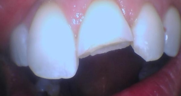 broken front tooth