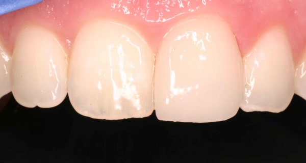 Close up of an actual patients mouth after receiving porcelain veneers in Poway CA that corrected her broken tooth