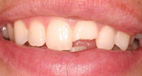 Close up of an actual patients mouth with a broken tooth before receiving porcelain veneers in Poway CA