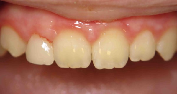 Close up of an actual patient mouth after receiving a smile makeover from Dr. Joe, a dentist in Poway, CA