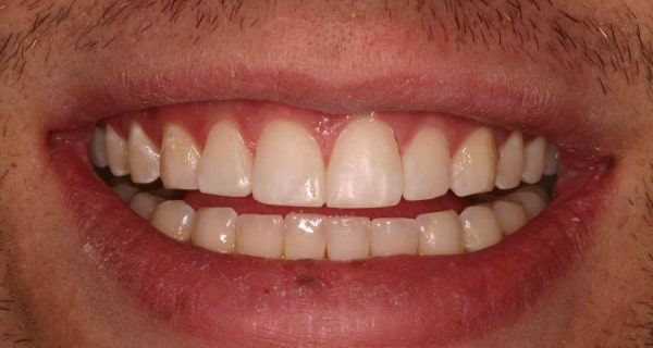 Close up of an actual patient mouth after receiving a smile makeover from Dr. Joe, a dentist in Poway, CA