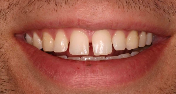 Close up of an actual patient mouth before receiving a smile makeover from Dr. Joe, a dentist in Poway, CA