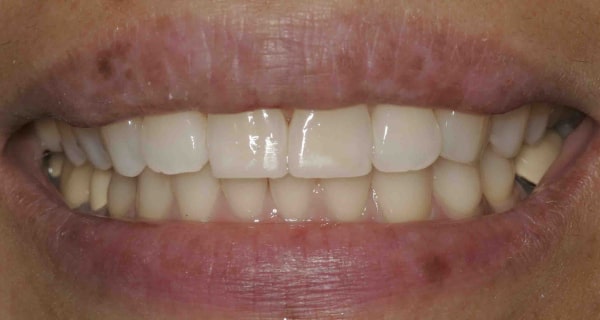 Close up of an actual patient mouth after receiving a smile makeover from Dr. Joe, a dentist in Poway, CA