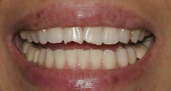 Close up of an actual patient mouth before receiving a smile makeover from Dr. Joe, a dentist in Poway, CA