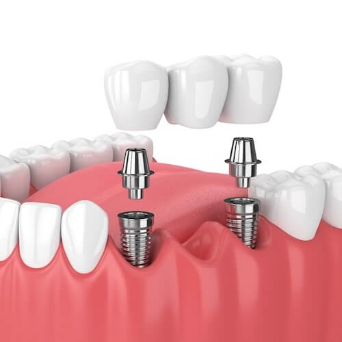 A representation of a dental implant anatomy