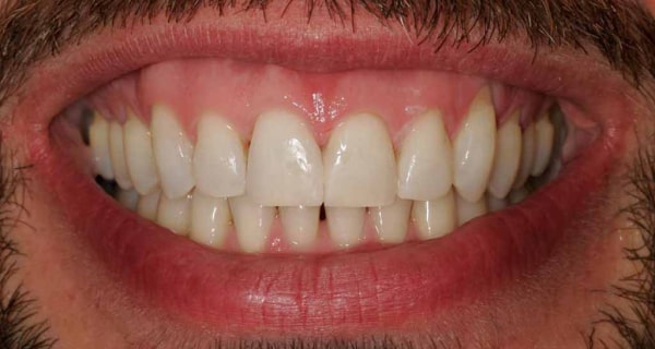 Close up of an actual patient mouth after receiving Invisalign and bonding as part of a smile makeover in Poway CA