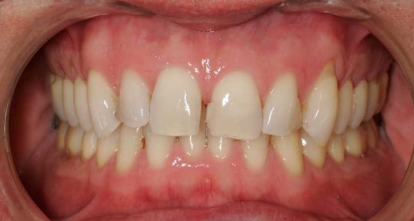 Close up of an actual patient mouth before receiving Invisalign and bonding as part of a smile makeover in Poway CA