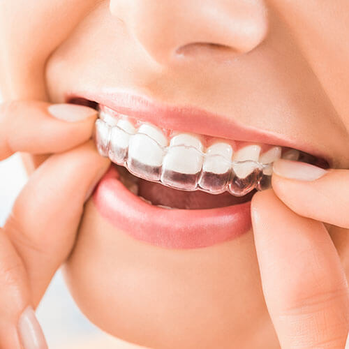 Close up of a patient placing their Invisalign clear aligners