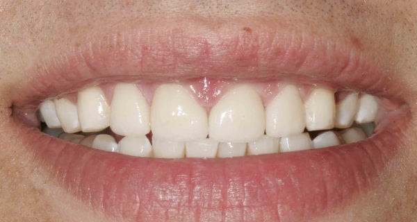 Close up of an actual patients mouth after receiving a smile makeover in Poway CA