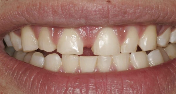 Close up of an actual patients mouth before receiving a smile makeover in Poway CA