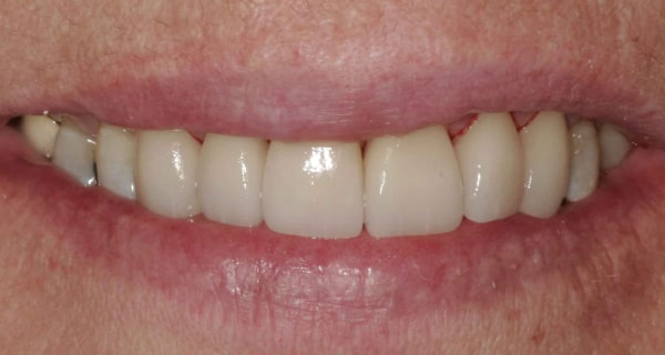 Close up of an actual patient mouth after receiving a smile makeover from Dr. Joe, a dentist in Poway, CA