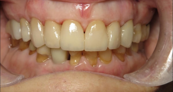 Close up of an actual patient mouth after receiving a smile makeover from Dr. Joe, a dentist in Poway, CA