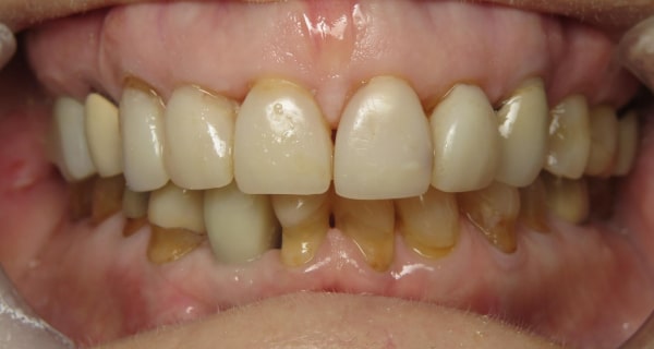 Close up of an actual patient mouth before receiving a smile makeover from Dr. Joe, a dentist in Poway, CA