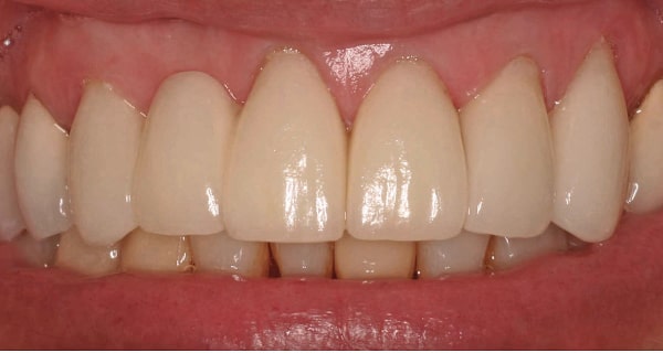 Close up of an actual patients mouth after a conservative smile makeover treatment