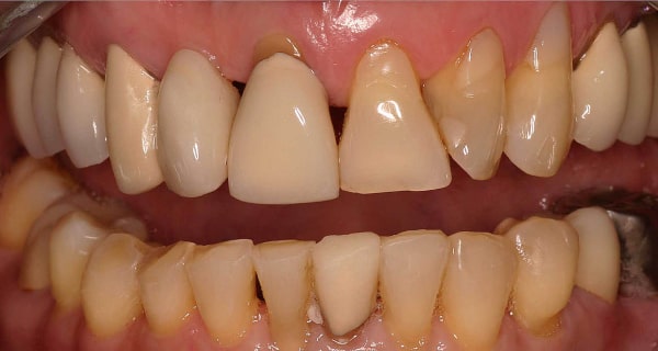 Close up of an actual patients mouth before receiving porcelain crowns as part of a smile makeover in Poway CA