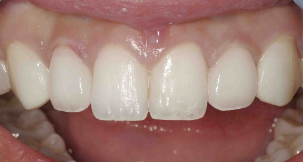 Close up of an actual patient mouth after receiving porcelain veners in Poway CA