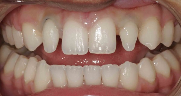 Close up of an actual patients mouth before receiving porcelain veneers in Poway CA