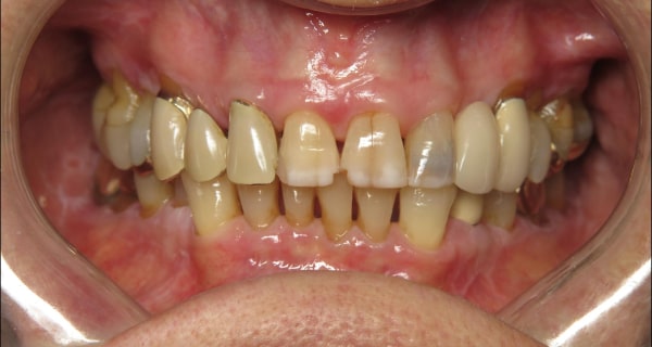 chipped teeth and leaking restorations