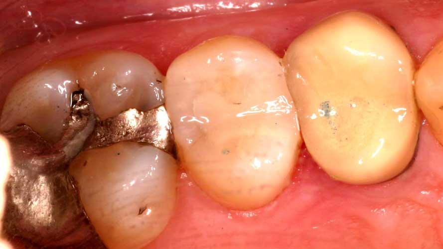 Tooth-Colored filling