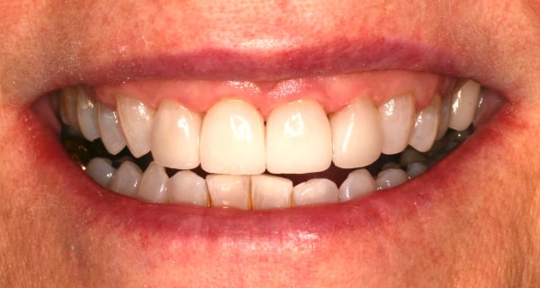 Close up of an actual patient mouth after receiving a smile makeover from Dr. Joe, a dentist in Poway, CA