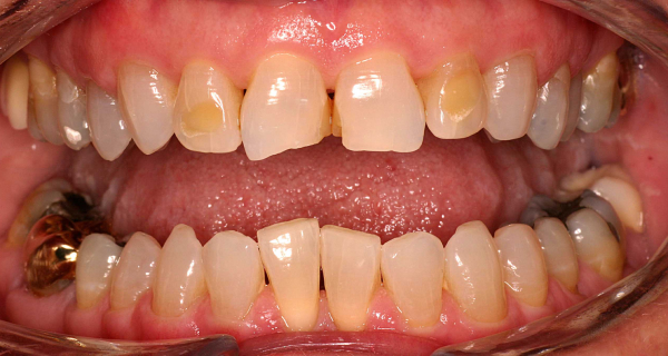 Close up of an actual patient mouth before receiving a smile makeover from Dr. Joe, a dentist in Poway, CA