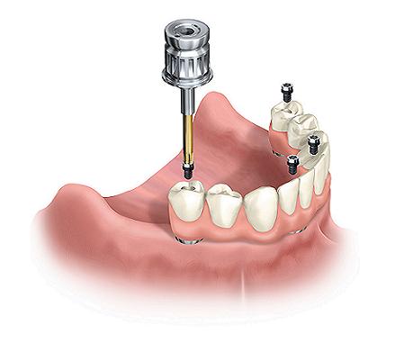 Illustration of all on 4 dental implants and how they are placed