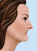 An illustration of bone loss due to missing teeth in its third stage