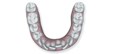 Illustration of crowded and rotated teeth to show that Invisalign in Poway, CA can correct this issue.