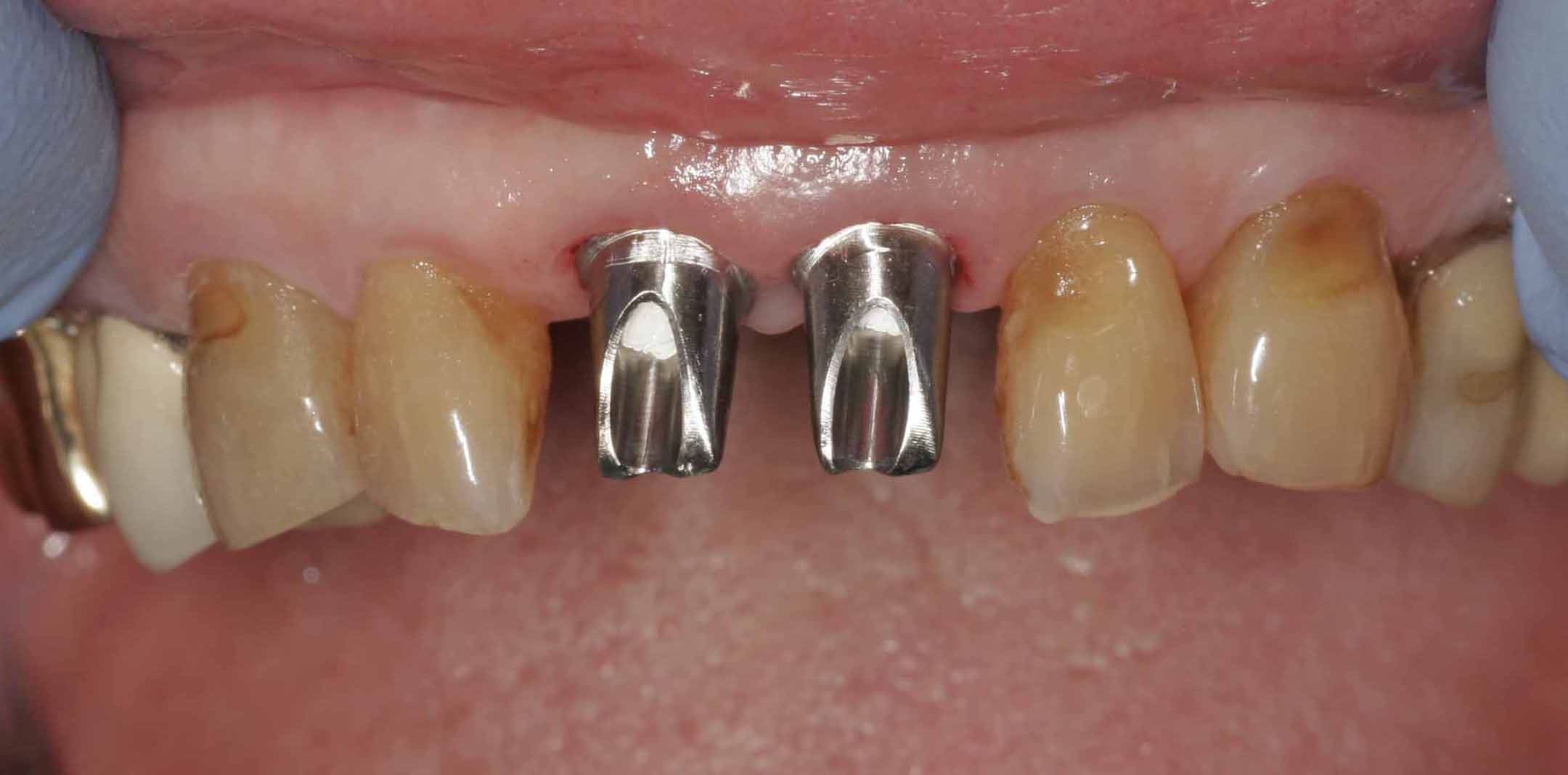 Close up of an actual patient mouth showing one of the phases of dental implants