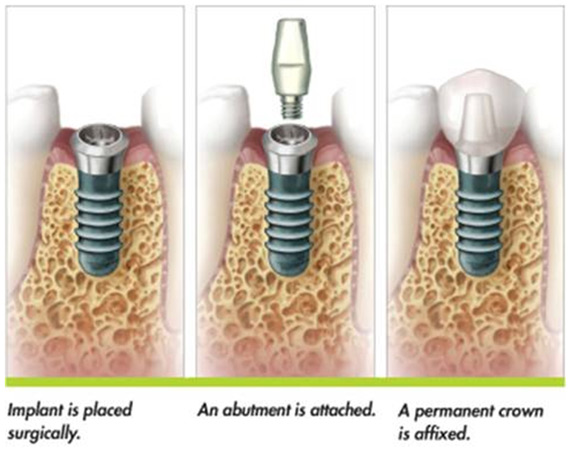 Illustration of how dental implants in Poway are placed.  