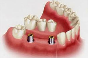 Illustration of a lower jaw with teeth and how dental implants in Poway are placed