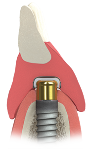 Illustration of an implant over a denture